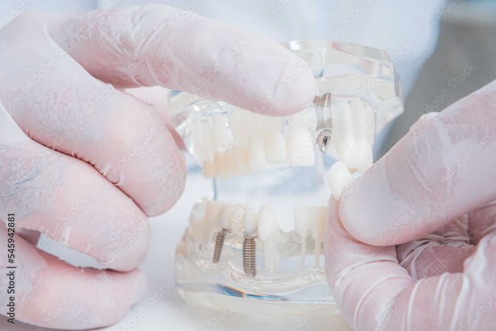 the orthodontist holds a model of teeth with implants in his hand and shows how to insert the tooth. Close up. Macro the orthodontist holds a model of teeth with implants in his hand and shows how to insert the tooth. Close up. Macro