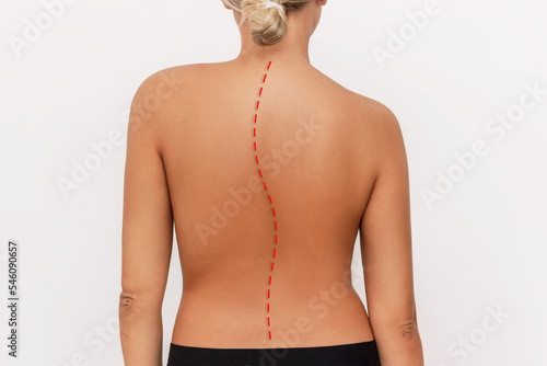 A young tanned woman with a crooked spine isolated on a white background. Incorrect spine position. Slouching back with different shoulder heights. Spinal deformity. Scoliosis photo