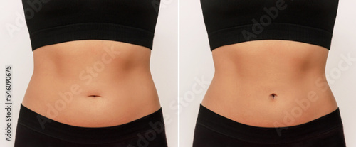 Two shots of a woman's belly with excess fat and toned slim stomach before and after navel correction. Plastic surgery on the bellybutton. Abdominoplasty, umbilicoplasty, lifting concept