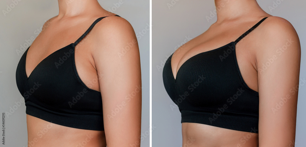 Foto de Young tanned woman in bra before and after breast augmentation with  silicone implants. The result of a breast lift. Breast size correction  isolated on a gray background. Plastic surgery concept