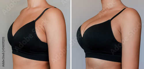 Young tanned woman in bra before and after breast augmentation with silicone implants. The result of a breast lift. Breast size correction isolated on a gray background. Plastic surgery concept photo