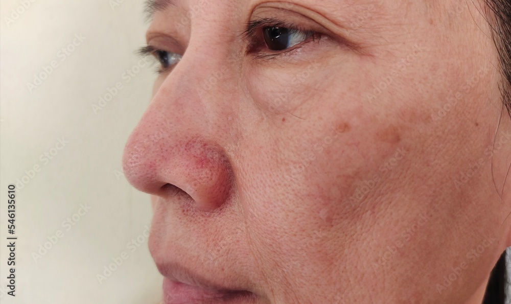 portrait showing the Wrinkles and flabby skin, freckles and blemish on the face, problem ptosis and Wrinkled beside the eyelid of the woman, health care and beauty concept.