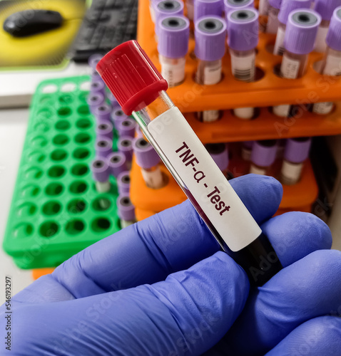Blood sample for TNF-α(Tumor necrosis factor alpha) test, an inflammatory cytokine produced by macrophages or monocytes during acute inflammation.