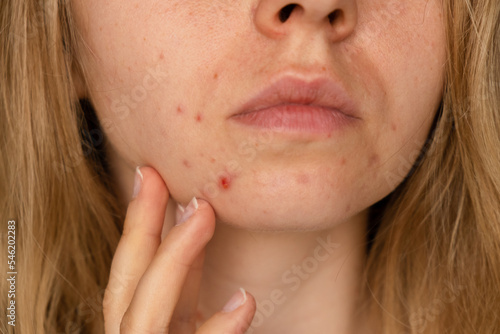 Unrecognizable woman showing her acne on face. Close-up acne on woman's face with rash skin ,scar and spot that allergic to cosmetics. Problem skincare and health concept. Wrinkles, melasma, dark photo