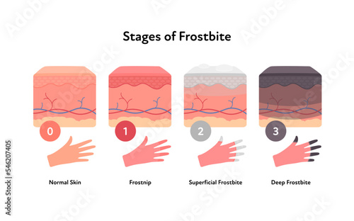 Frostbite anatomical infographic. Vector flat healthcare illustration. Stages of hypothermia and windburn. Skin layers and hand with fingers and stage number. Design for dermatology