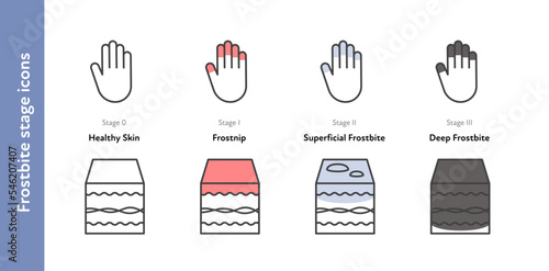 Frostbite anatomical icon set. Vector flat healthcare illustration. Stages of hypothermia. Skin layer and hand with finger symbol. Frostnip, superficial, deep stage. Design for infographic dermatology