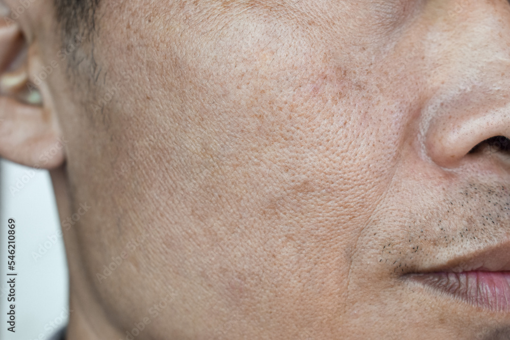 Fair skin with wide pores in face of Asian, Myanmar or Korean man. Fair skin with wide pores in face of Asian, Myanmar or Korean man.
