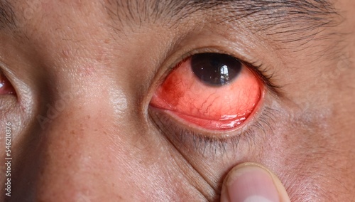 Corneal infection or ulcer called keratitis in Asian man. photo