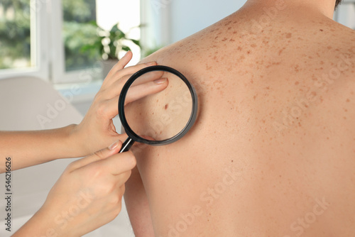 Dermatologist examining patient's birthmark with magnifying glass in clinic, closeup