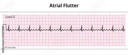 ECG Atrial Flutter - 8 Second ECG Paper