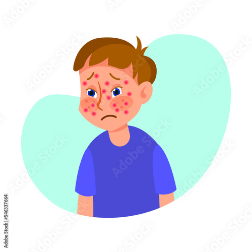 Ill boy with large skin rash on face flat vector illustration. Cartoon kid with symptoms of allergy isolated on white background. Health, disease concept