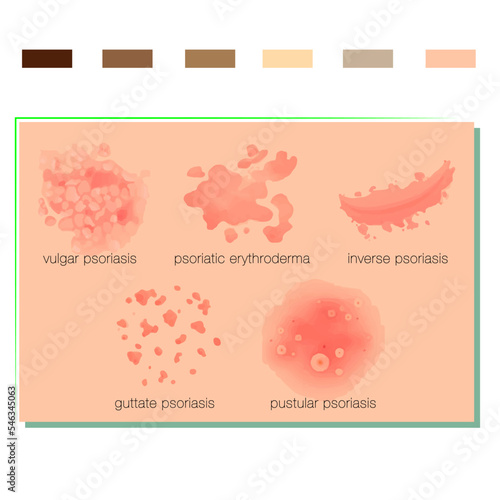 Psoriasis Vector Art