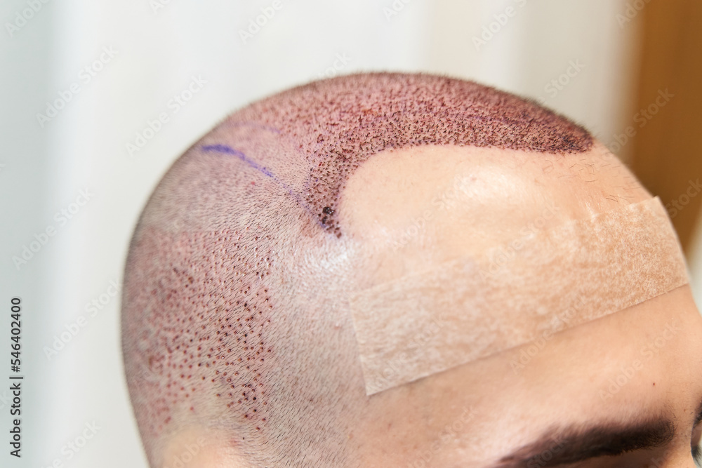 Fototapeta premium End to baldness concept. Male scalp after hair implant surgery