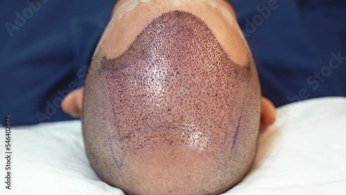 Top view of scalp after hair transplant surgery