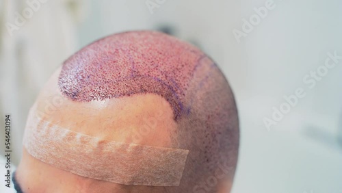 Detail of hair line after hair transplant surgery to cure baldness at clinic