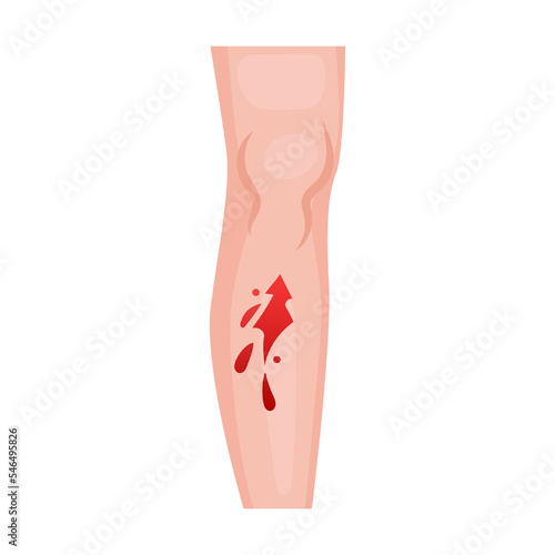 open wound on leg, heart. Traumas of skin on body part. Vector illustration of open cut wounds with bleeding, fracture and bruise. Cartoon isolated on white