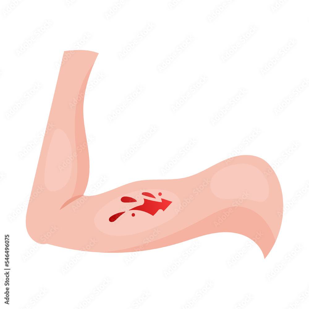 open laceration on arm. Traumas of skin on body part. Vector illustration  of open cut wounds with bleeding, fracture and bruise Stock Vector