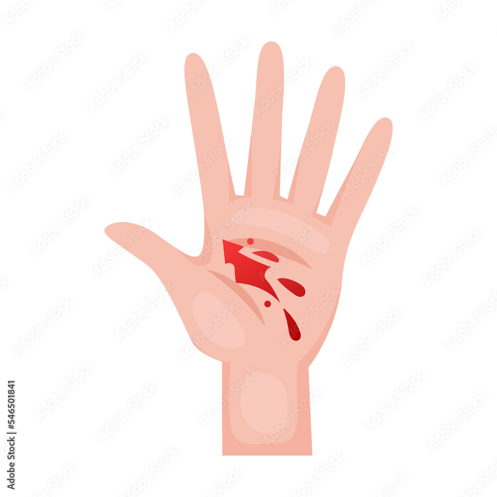 open wound on palm of hand. Traumas of skin on body part. Vector