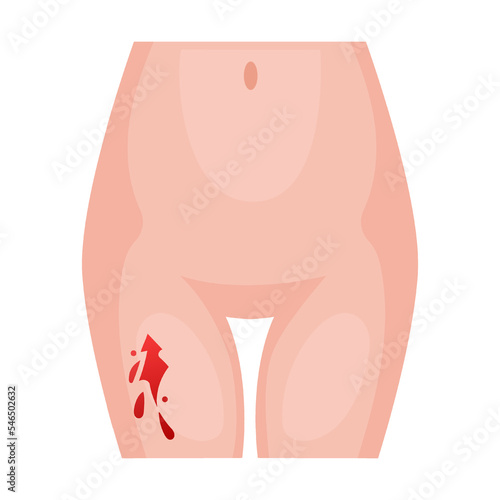 deep cut on leg. Traumas of skin on body part. Vector illustration of open cut wounds with bleeding