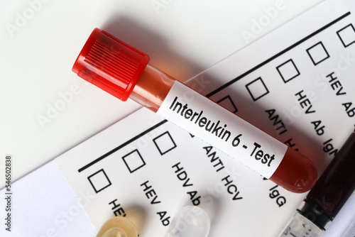 Interleukin 6 test to look for abnormalities from blood photo