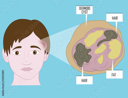 Dermoid cysts symptoms on young patient face. Illustration. photo