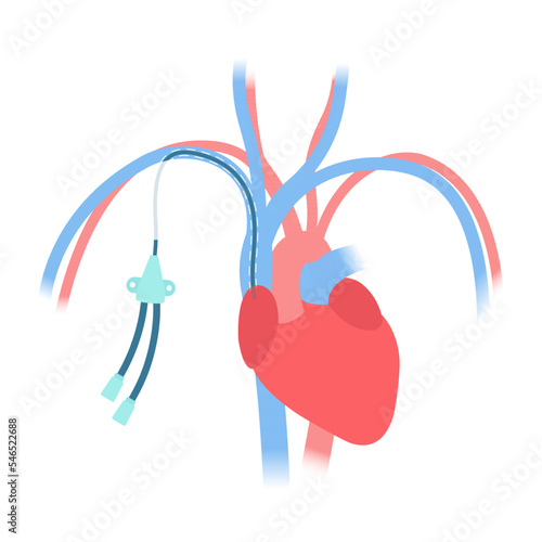 Tunneled central venous catheter placed in the subclavian vein. Patient with CVC long term access device for chemotherapy infusions and blood sampling. Central line tube close up. Vector illustration.