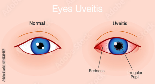 Uveitis eye anterior anatomy. Irritation, swelling, red infection, blurred vision, irregular pupil symptoms. Bleeding, inflammation eyes. Normal, ill iris. Skin color background, illustration vector