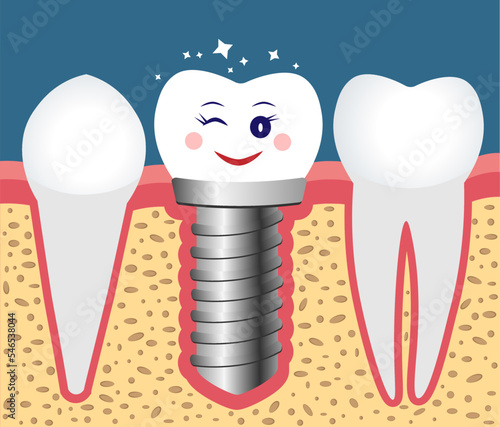 It's a dental implant for the perfect smile. White teeth in the jaws