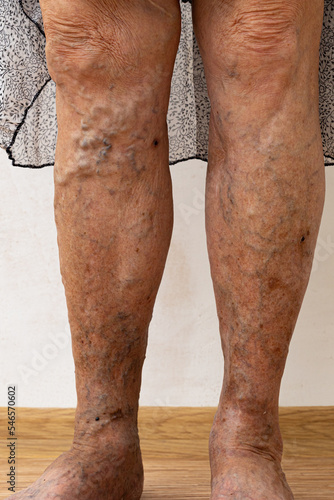 Vertical unrecognizable senior woman bare legs with protruding varix, spider varicose veins medical condition. Checking health thrombosis, thrombophlebitis. Need surgeon operation for blood vessels
