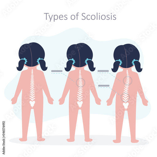Educational poster with different types of scoliosis. Child with disorders of musculoskeletal system. Example of scoliosis of varying degrees. Spinal curvature concept. Back view.