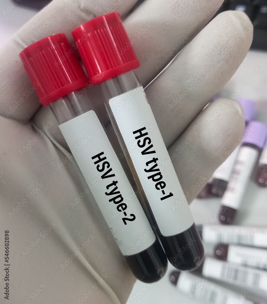 Blood sample HSV (type1 and 2) test to detect Herpes simplex virus