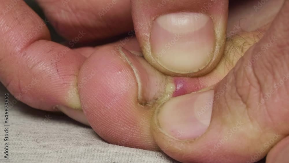 Man squeezes pus from a callus near his big toe nail Man squeezes pus from a callus near his big toe nail