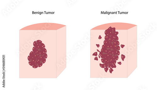 Tumor cells. Benign and malignat tumor illustration in a skin.  