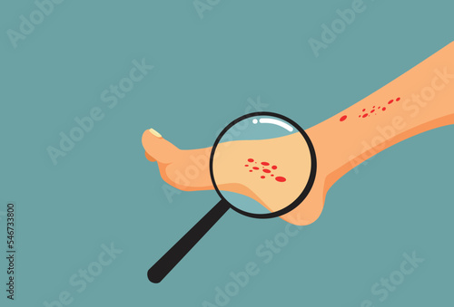Person with Skin Eczema on the Foot Going Under Medical Examination. Person undergoing a dermatological examination because of a skin rash
