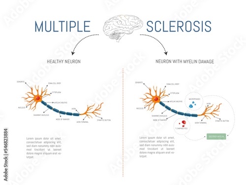 Infographic of a healthy neuron and one with damage from attack by myelin-destroying lymphocytes and macrophages in multiple sclerosis disease.