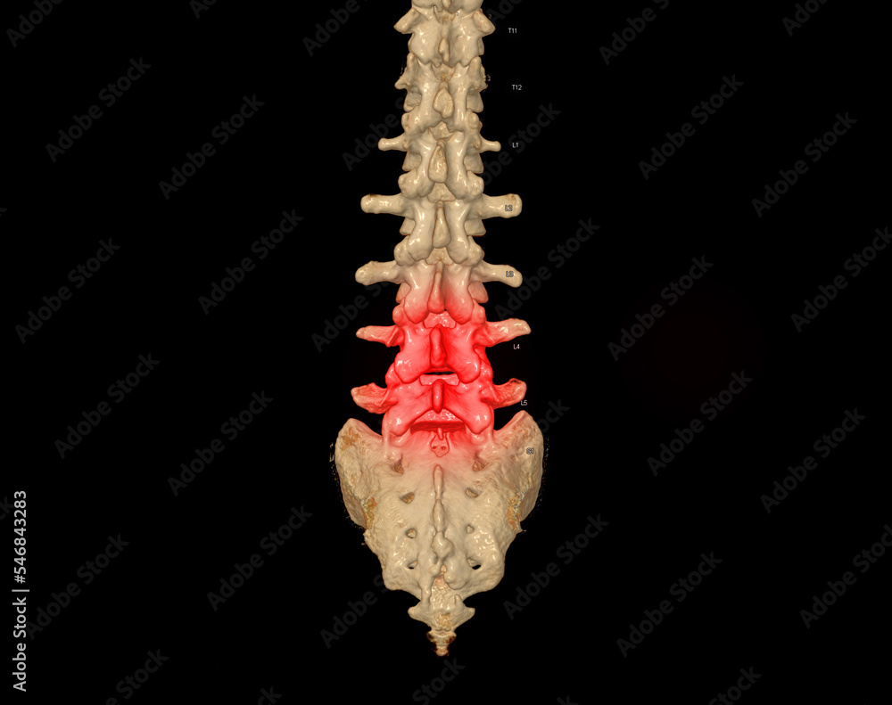 CT scan of Lumbar spine 3D rendering showing Profile Human Spine. Stock ...