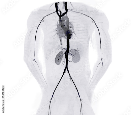 CTA whole aorta and brachial artery 3D rendering image in case patient tramatic. photo