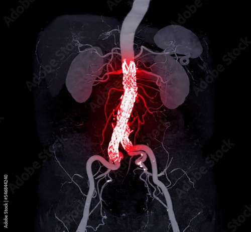 Φωτογραφία CTA whole aorta with Abdominal aorta stent graft compare 3D rendering image