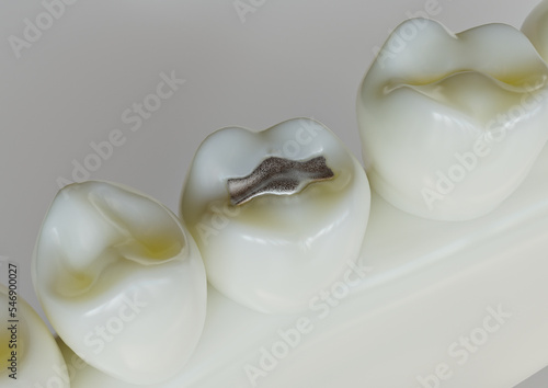 Amalgam restorationn in a tooth - 3D Rendering