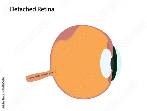 Detached retina illustration. Eye with detached retina  photo