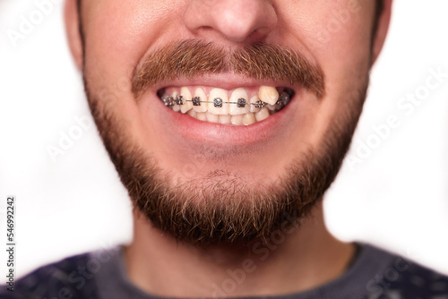 Bearded man with dental braces on a white background