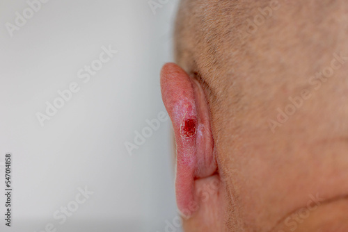 Canvas Print Healthcare and medical concept, Selective focus of back side of a man with grey hair, The ear with lesion ear pit with pus, Blister and lymph on a man behind the auricle, swelling wound red blood