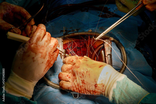 Process of coronary artery bypass graft CABG for heart operations due to coronary heart disease takes place in the operating room a hospital photo