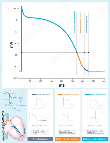Obraz na plátně Impulse encountering effective refractory period will lead to interruption of transmission, while encountering relative refractory period will lead to delay of transmission