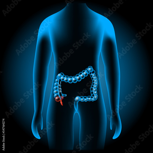 Appendicitis. inflammation of the appendix. Red vermix, or part of cecum into x-ray blue realistic torso. large intestine.