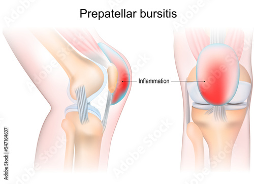 bursitis of human knee joint. Prepatellar bursitis.