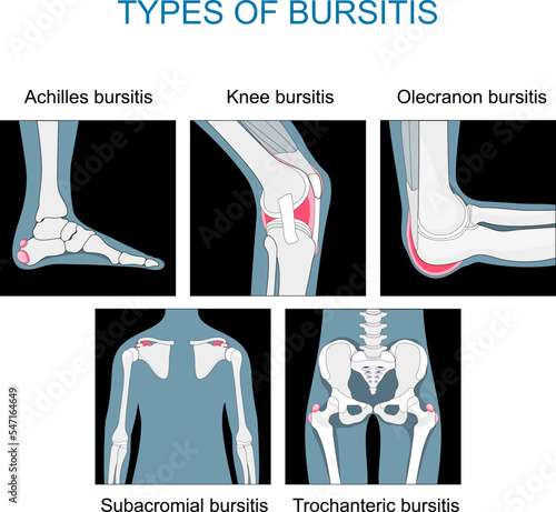 Types of bursitis. monochrome flat vector like x-ray illustration