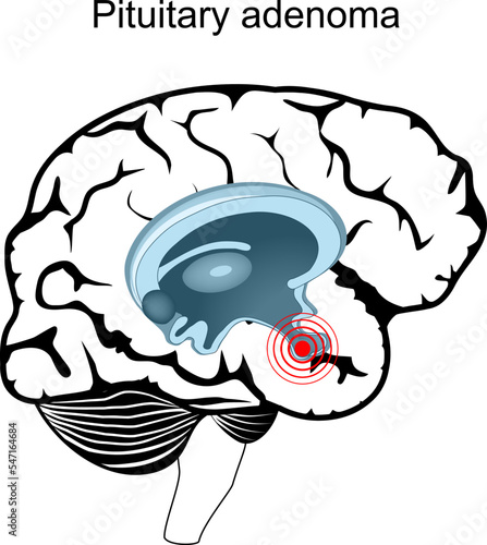 Pituitary adenoma. Cross section of human brain.