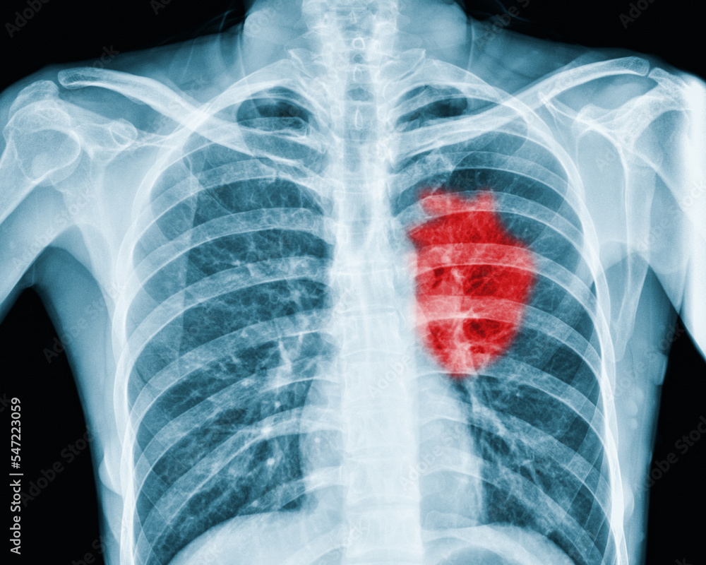 x-ray red heart of human Inflammation and signs of a red heart (heart disease) x-ray red heart of human Inflammation and signs of a red heart (heart disease)