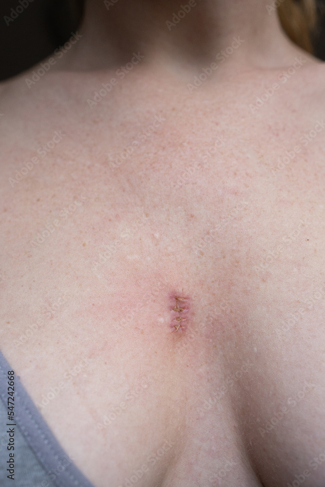 A wound that heals and turns into a scar after removing a cyst on a woman's breast.
A wound on chest. A wound that heals and turns into a scar after removing a cyst on a woman's breast.
A wound on chest.